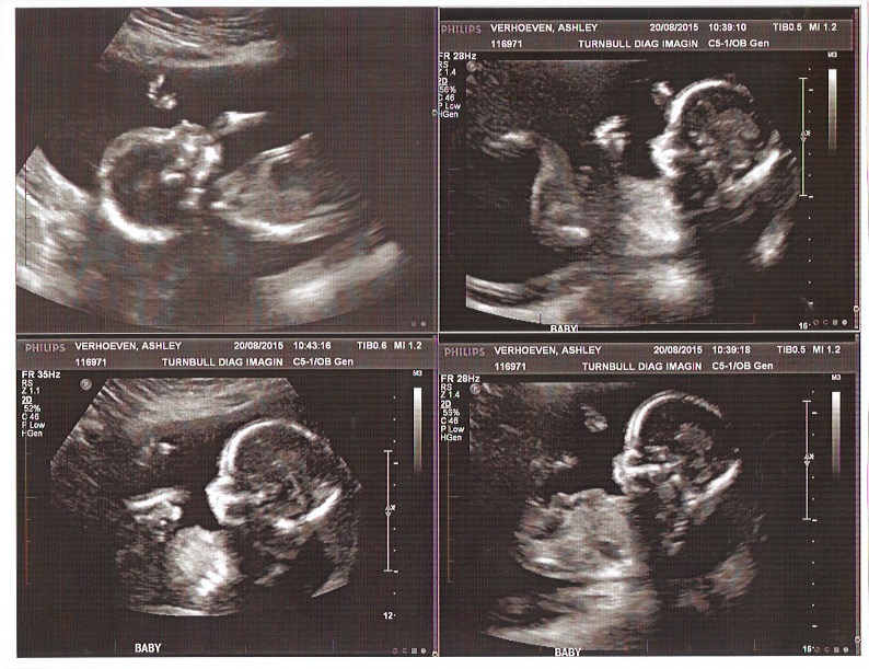 SIMAP 16 – 18 Week Ultrasound